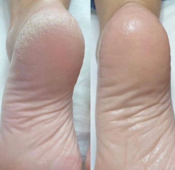 Миттєвий пілінг LovaSkin-результати догляду