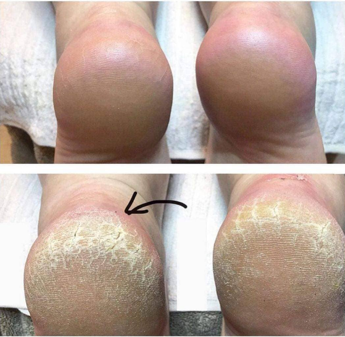 Результати застосування миттєвого пілінгу LovaSkin.